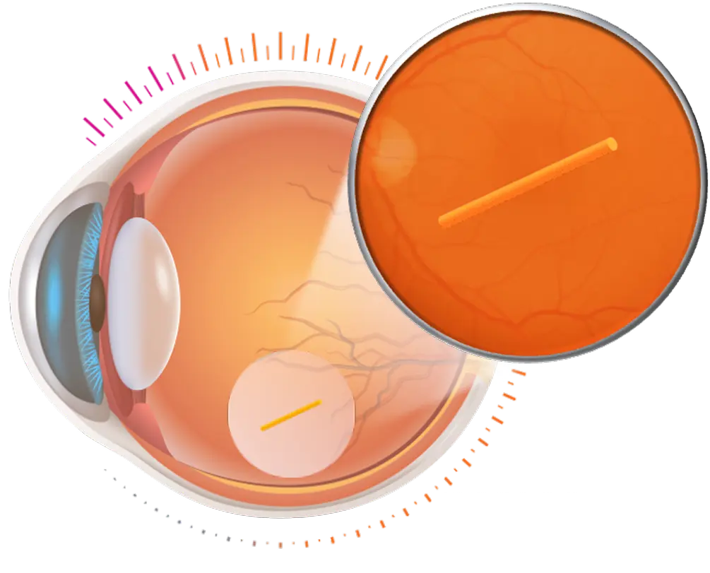 Next-generation bioerodible intravitreal insert
