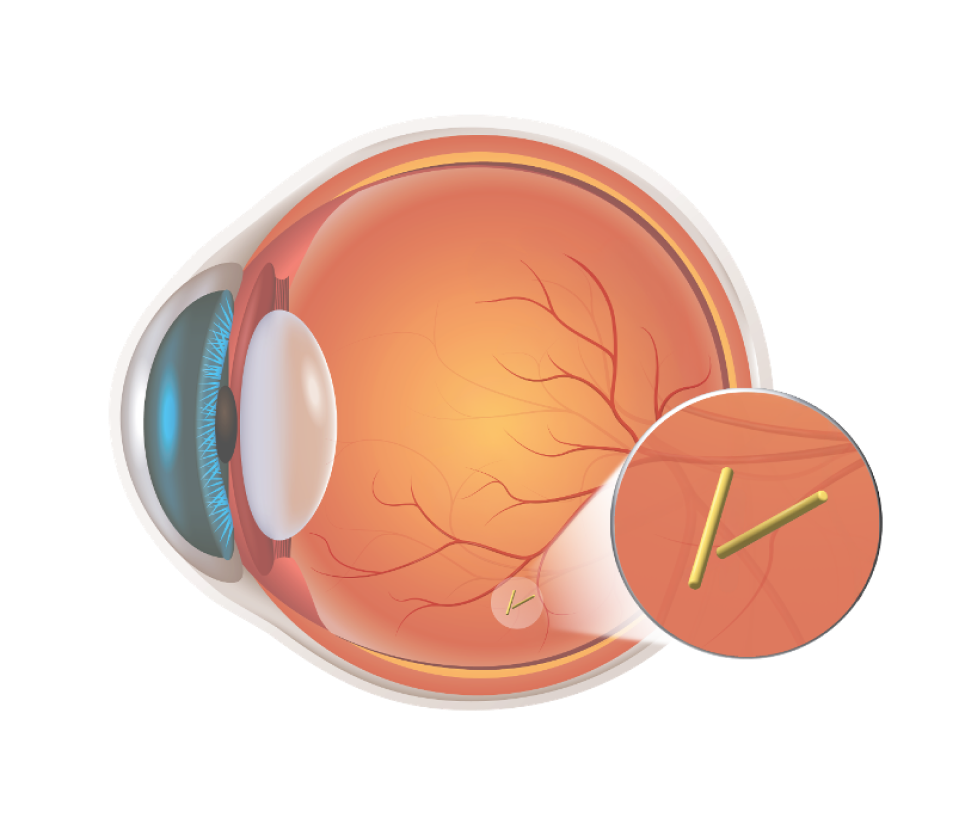 Next-generation bioerodible intravitreal insert